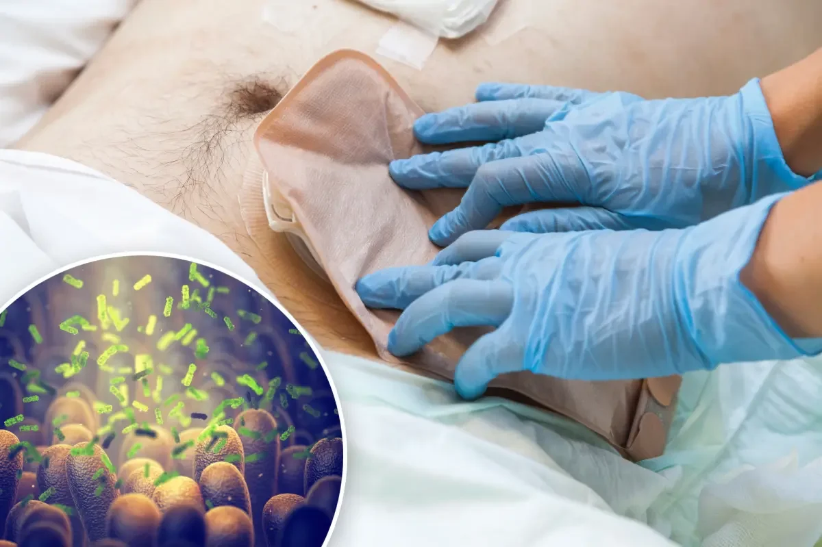 Gut microbiome clues point to earlier colorectal cancer detection