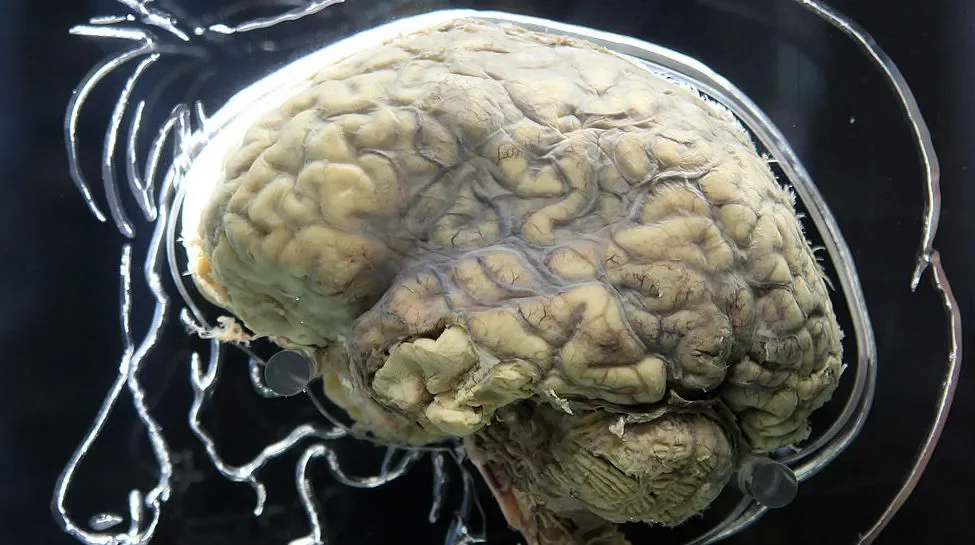 The Mystery of Consciousness in Dying Brains.
