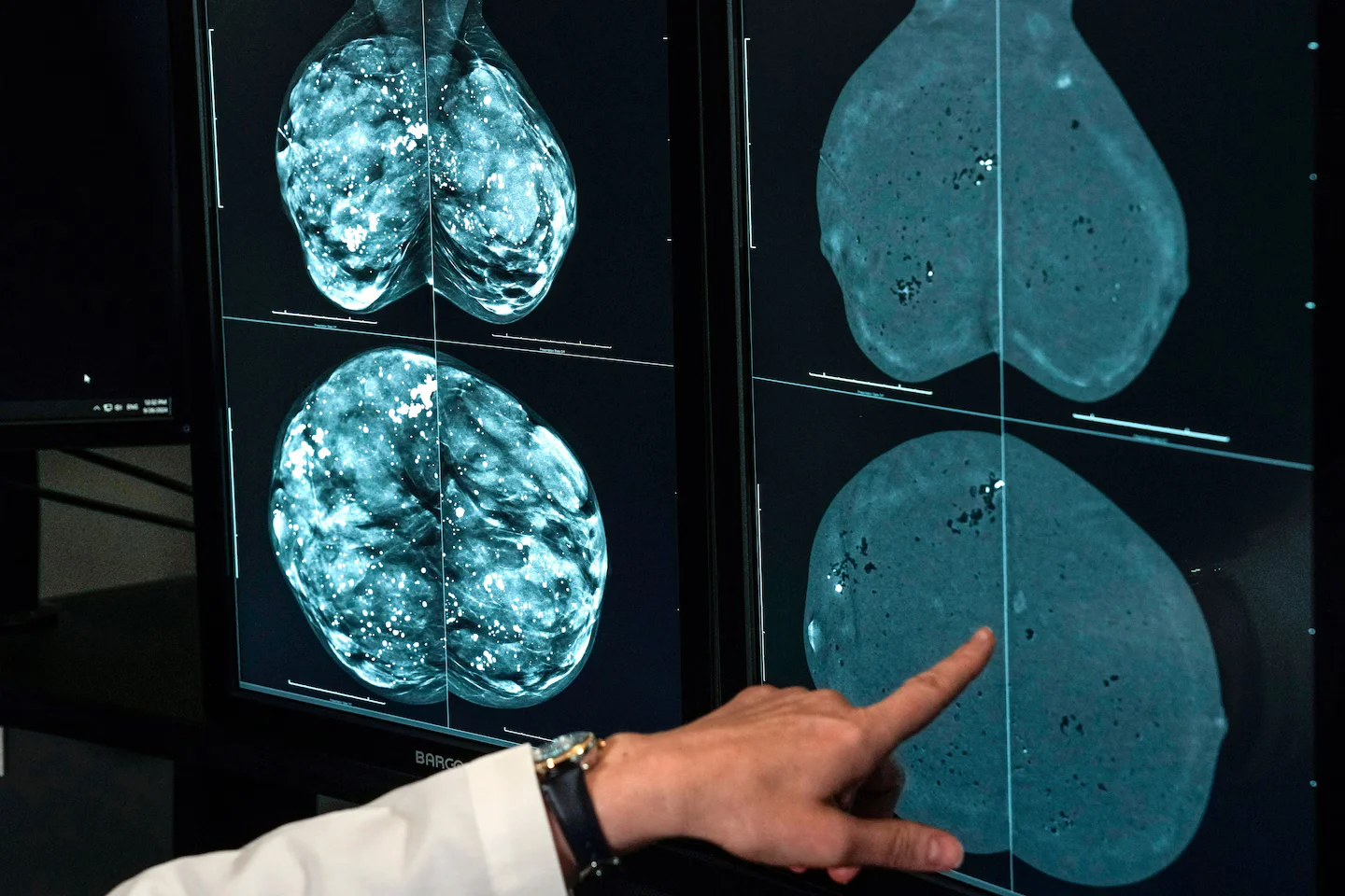 WHO warns a global cancer surge is coming by 2050, fueled by inequities