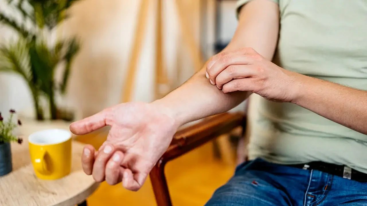 Scratch That Itch: Study Links Scratching to Longer Eczema Flare via Mast Cells