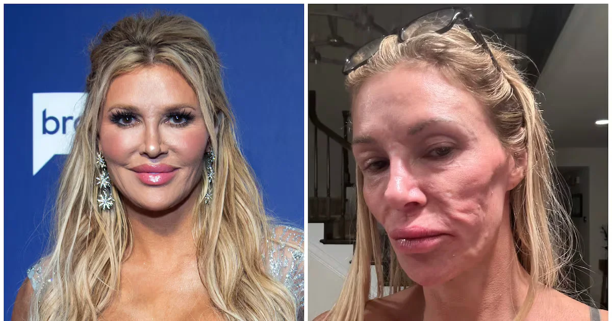 Brandi Glanville Reveals Benign Facial Tumor After Years of Searching for Answers