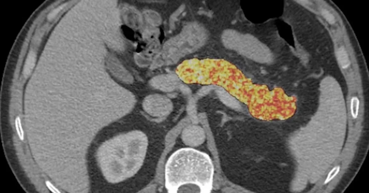 AI detects early pancreatic cancer clues years before tumors form