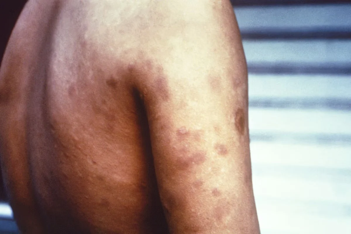 Florida reports rising Hansen’s disease cases with guidance to cut risk