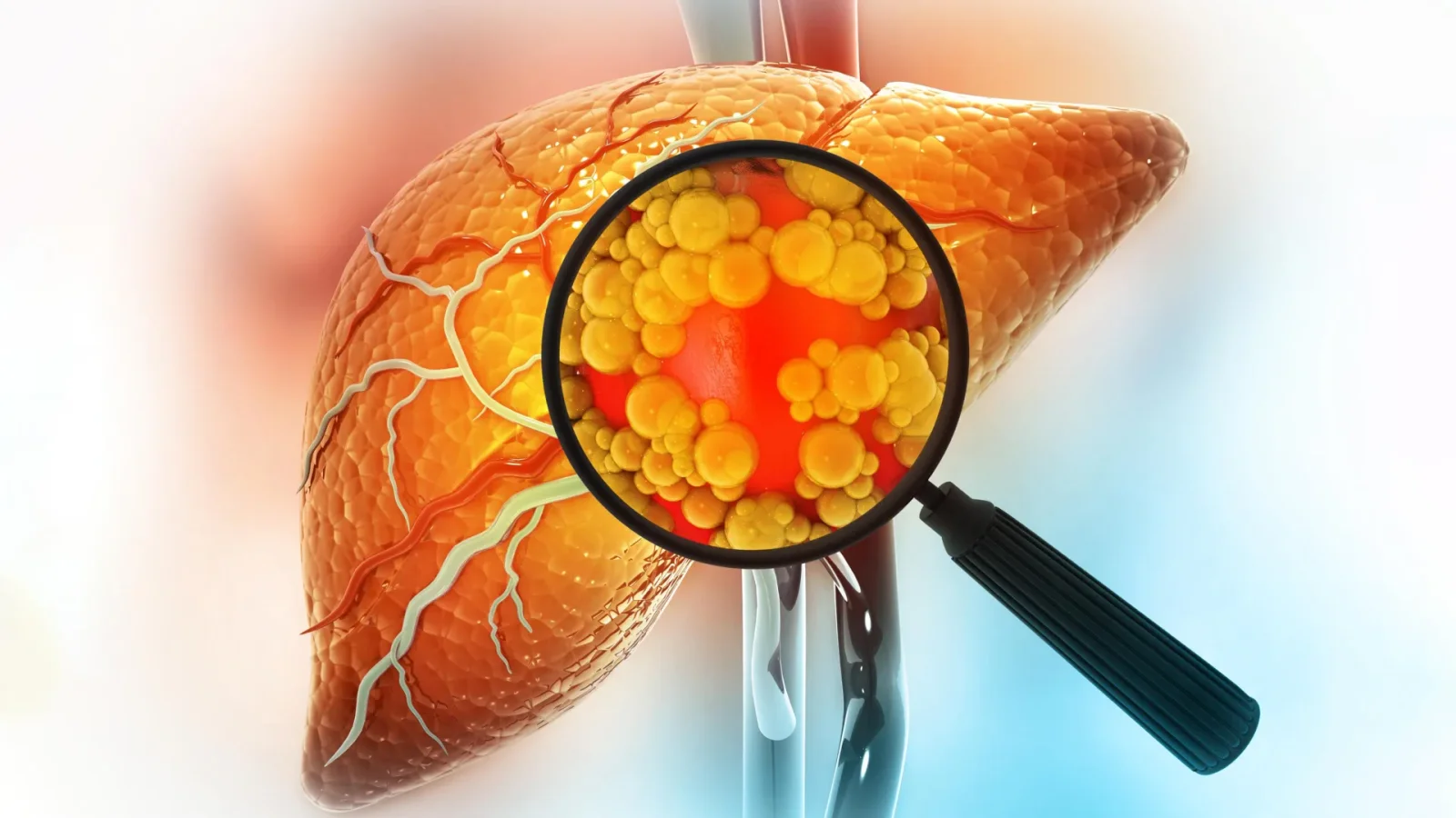 DT-109 Reverses Severe Fatty Liver Disease by Repairing the Gut Barrier