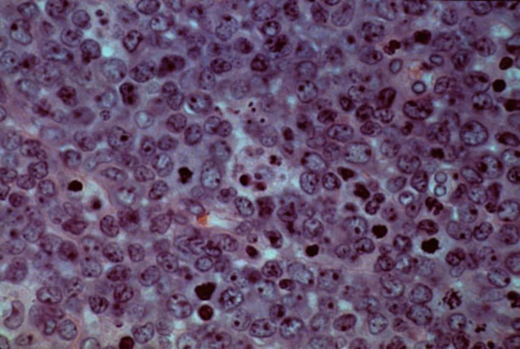 Off-the-shelf CAR-T shows potential to delay lymphoma relapse in interim Phase 3 results