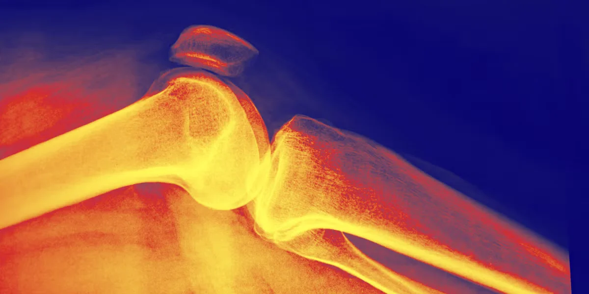 Bone Density Gains Take Time: 1 to 3 Years to See Real Change