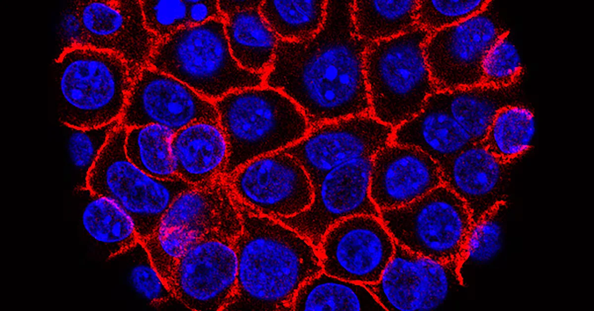 Georgia hospitals launch trials of a promising pancreatic cancer drug