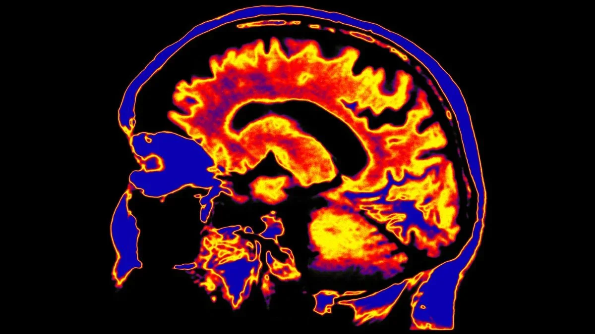 Glymphatic System Dysfunction Linked to ME/CFS, Australian Study Suggests