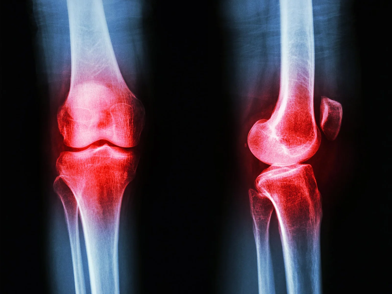 Joint GLP-1 Hint Opens Door to New Arthritis Treatments