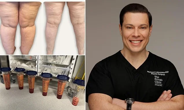 Lipedema: the real culprit behind stubborn menopausal fat—and how to shift it