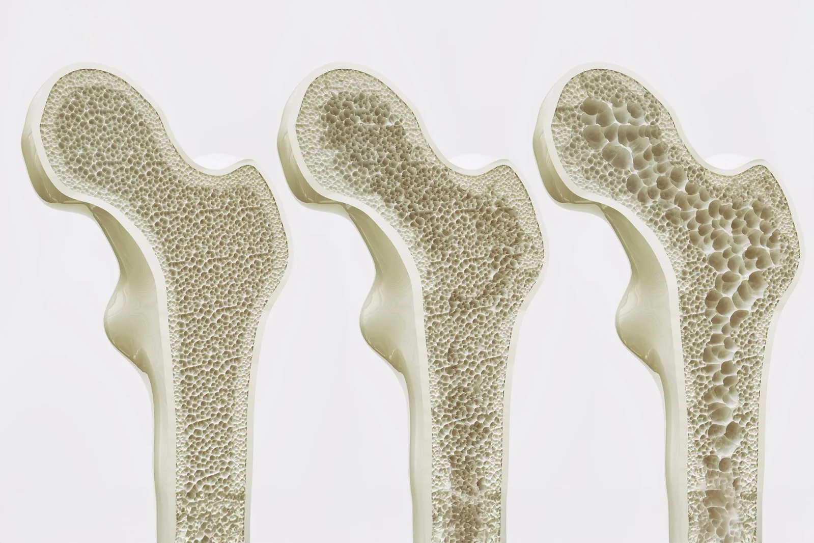 GPR133 Receptor Emerges as a New Target to Strengthen Bones