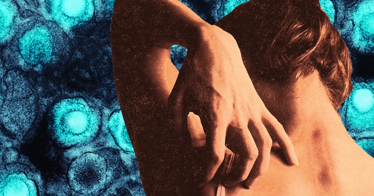 Shingles Strikes Millennials: A Wake‑Up Call for Women Under 50