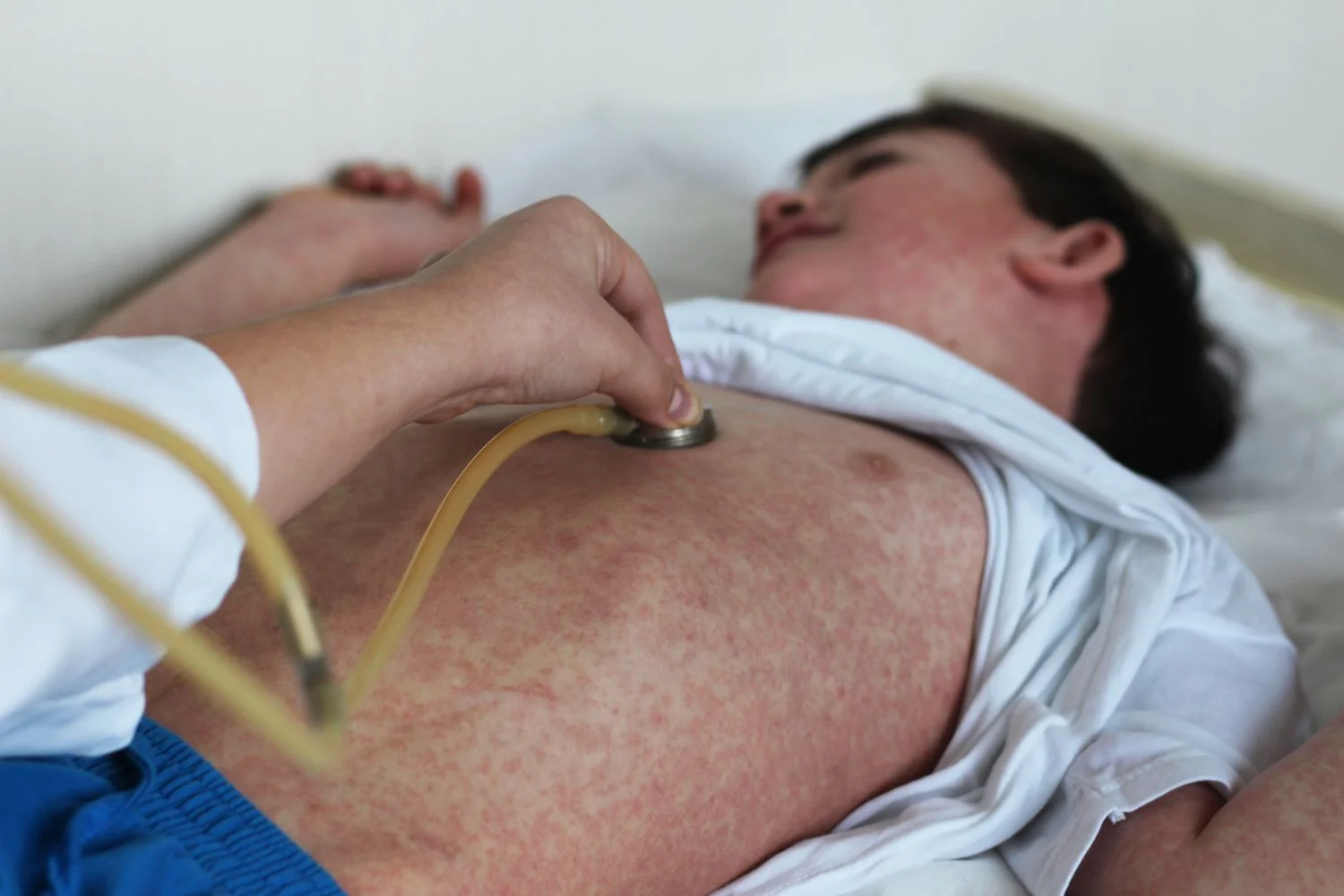 Measles on the brink: US elimination status at risk as experts outline next steps