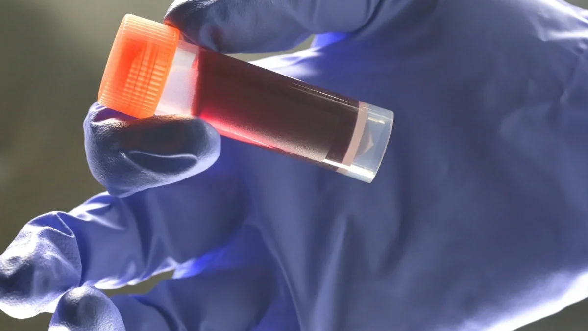 A Blood Type May Elevate Risk of Early-Onset Stroke, New Research Finds