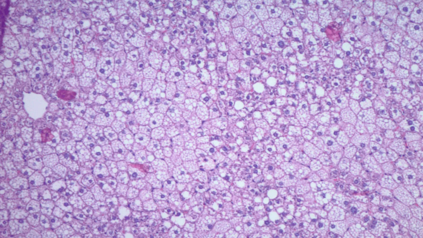 Food-Systems Lens Links Western Diet and Binge Drinking to Rapid Fatty Liver Progression