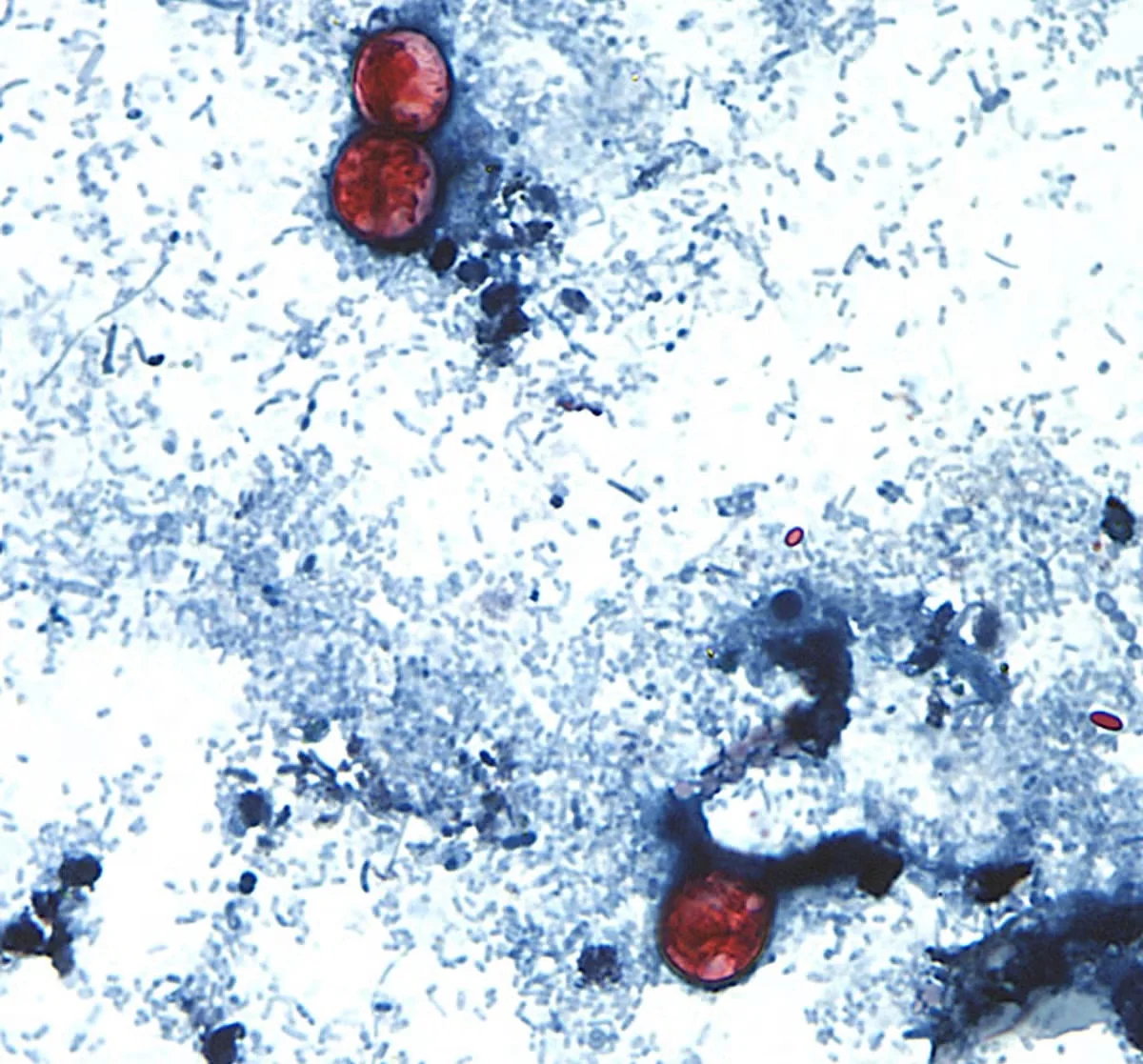 Cyclospora cases surge in PA and NJ, prompting health guidance