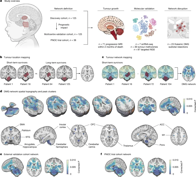 Brain-wide network links prognosis to pediatric diffuse midline glioma survival