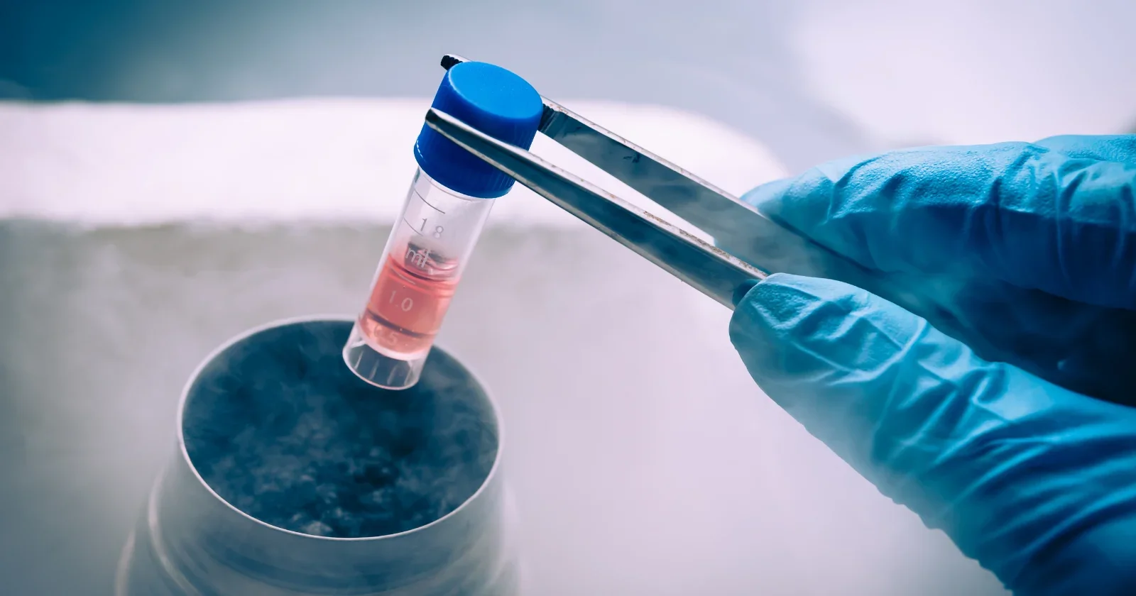 Autologous CiPSC Islet Transplant Brings Insulin Independence to Type 1 Diabetes Patient
