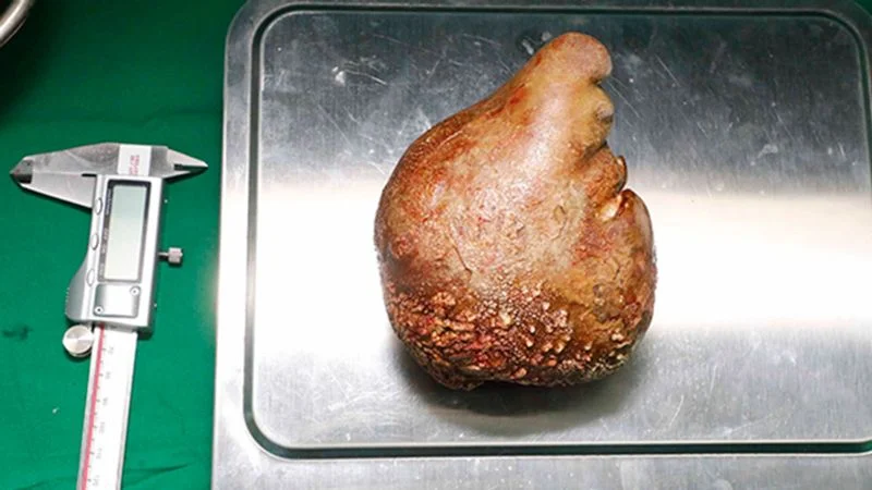 Grapefruit-sized kidney stone successfully removed.
