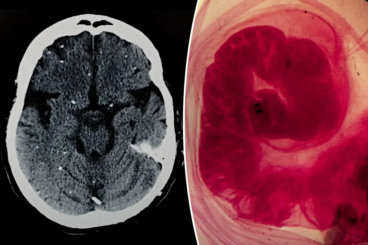 Brain Cancer Panic in Spain Turns Out to Be a Pork Tapeworm in the Brain