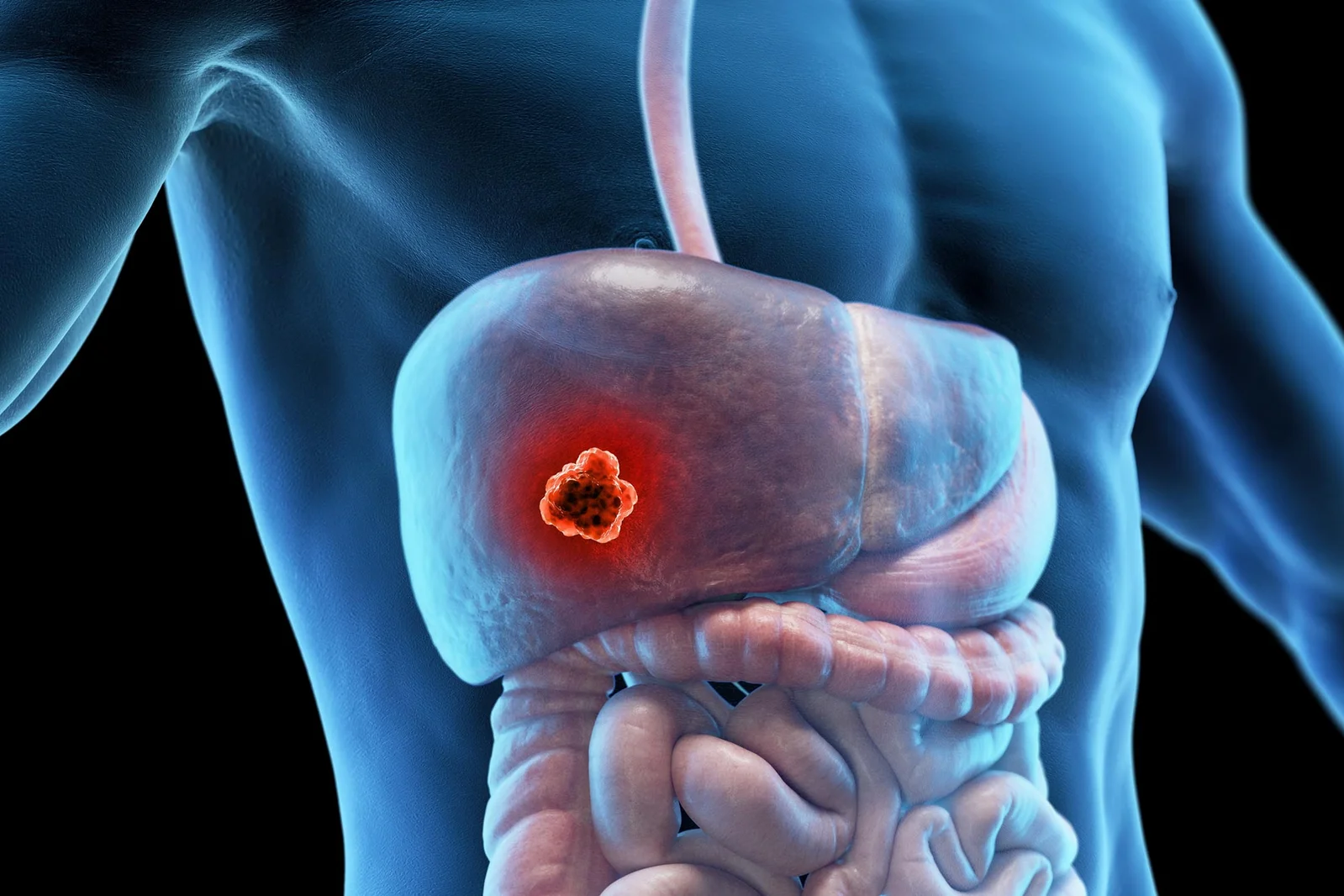 Resmetirom May Guard Against Fatty Liver-Linked Liver Cancer, Study Finds