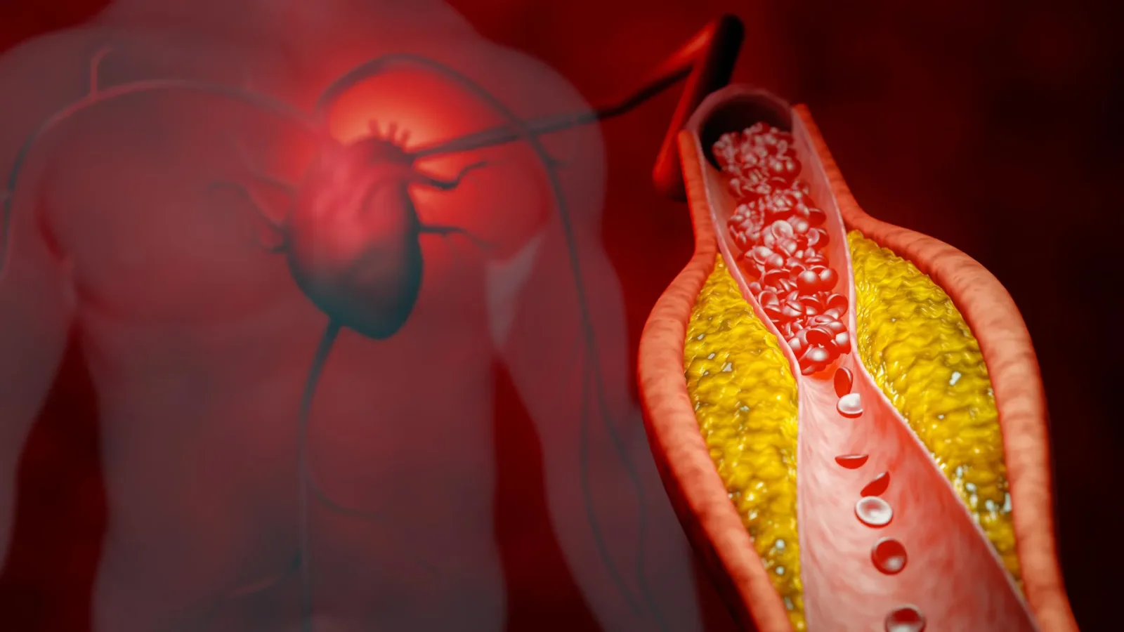 ApoB Testing Could Sharpen Cholesterol Therapy Decisions