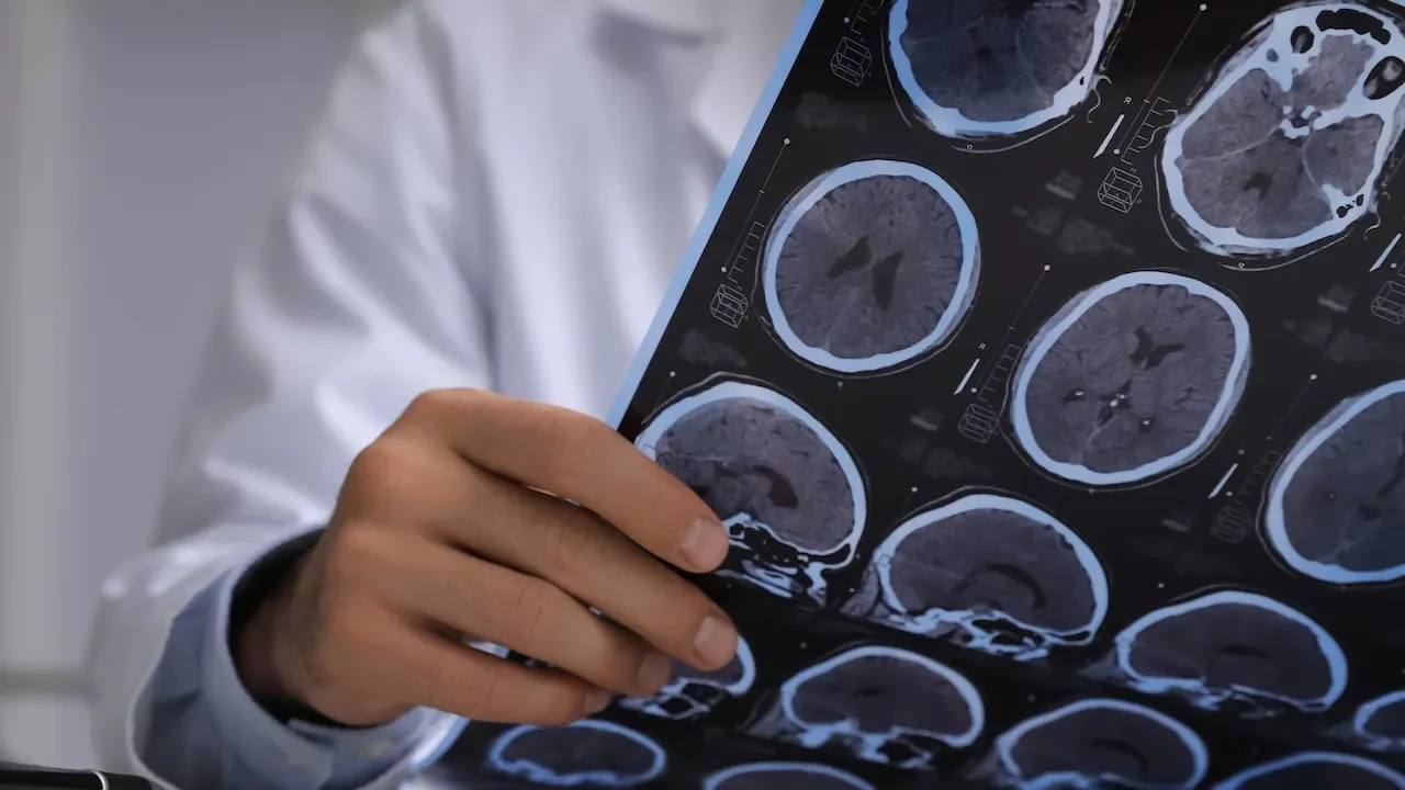 Tapeworm Mimics Brain Cancer in Spain Case Highlights Neurocysticercosis