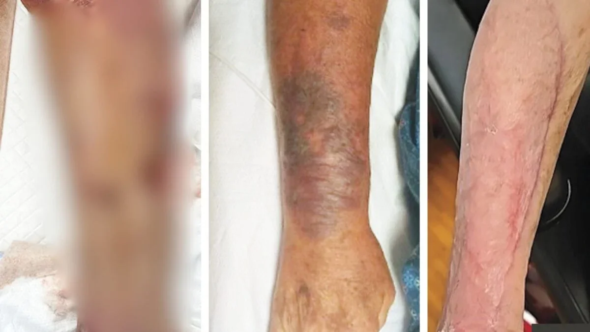 Warm Seas, Deadly Bacteria: A Florida Case of Vibrio vulnificus That Cost a Leg