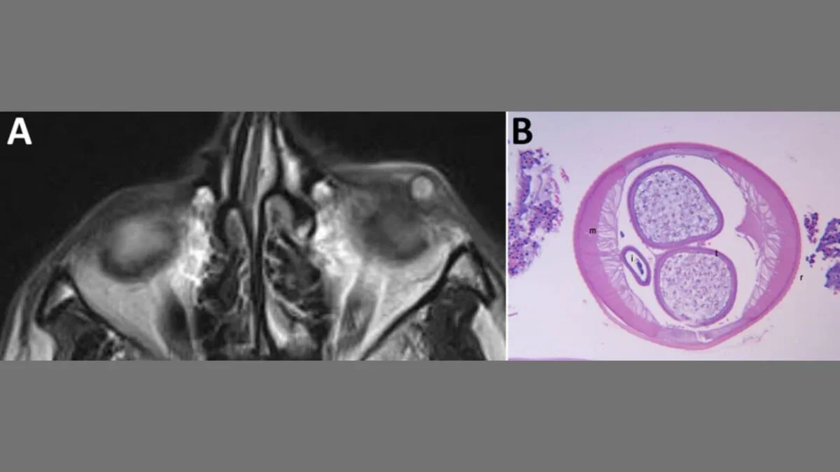 Rare European Eye Worm Detected in U.S. Eyelid Case, First of Its Kind