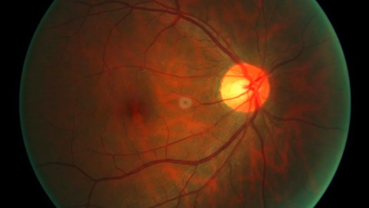 First Patient Dosed in Eye Aging Reversal Trial