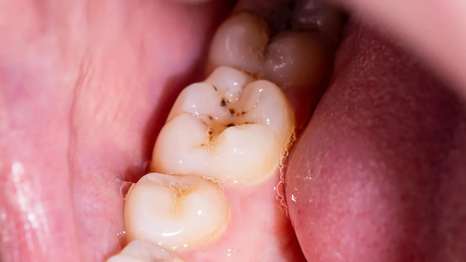 Gel Rebuilds Tooth Enamel Without Fluoride