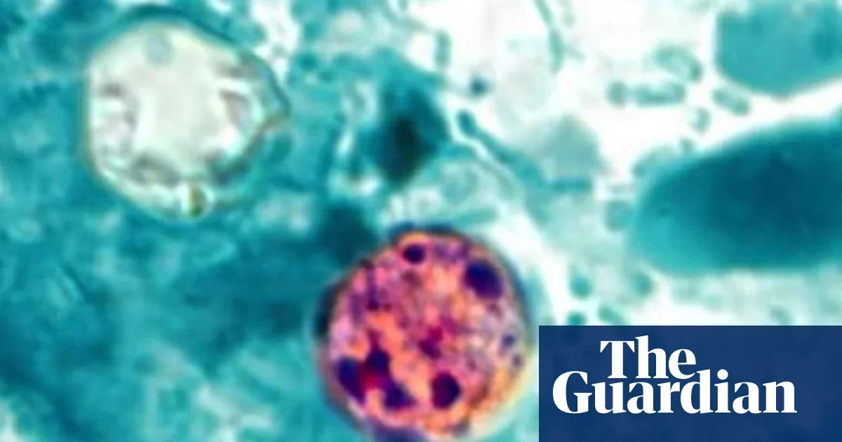 Surging cyclosporiasis outbreak prompts public health warning in US