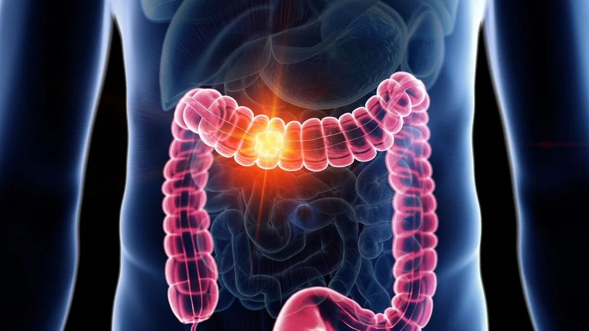 Processed Meats Linked to 80% of Colon Cancer Cases, Says Veteran Oncologist