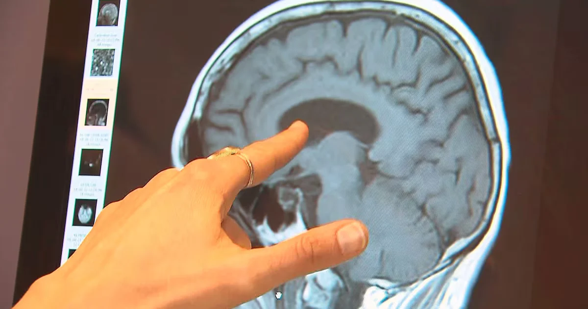 WHO: Modifiable factors could cut up to 45% of dementia risk
