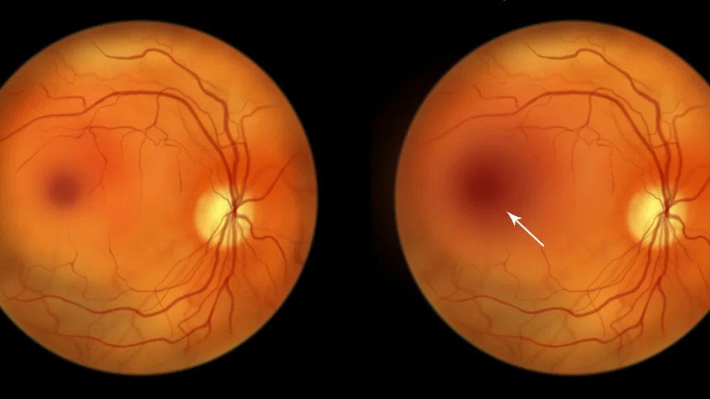 Ollin Biosciences bags $330M to push eye-disease therapy into Phase 3