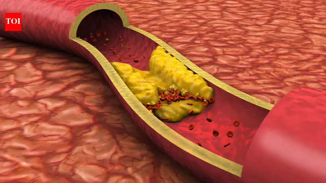 New ACC/AHA cholesterol guidelines push early prevention and broader testing