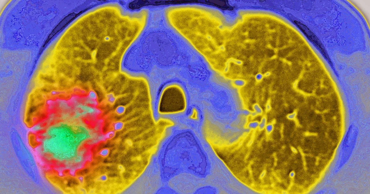 GLP-1 diabetes drugs linked to slower cancer progression in early study