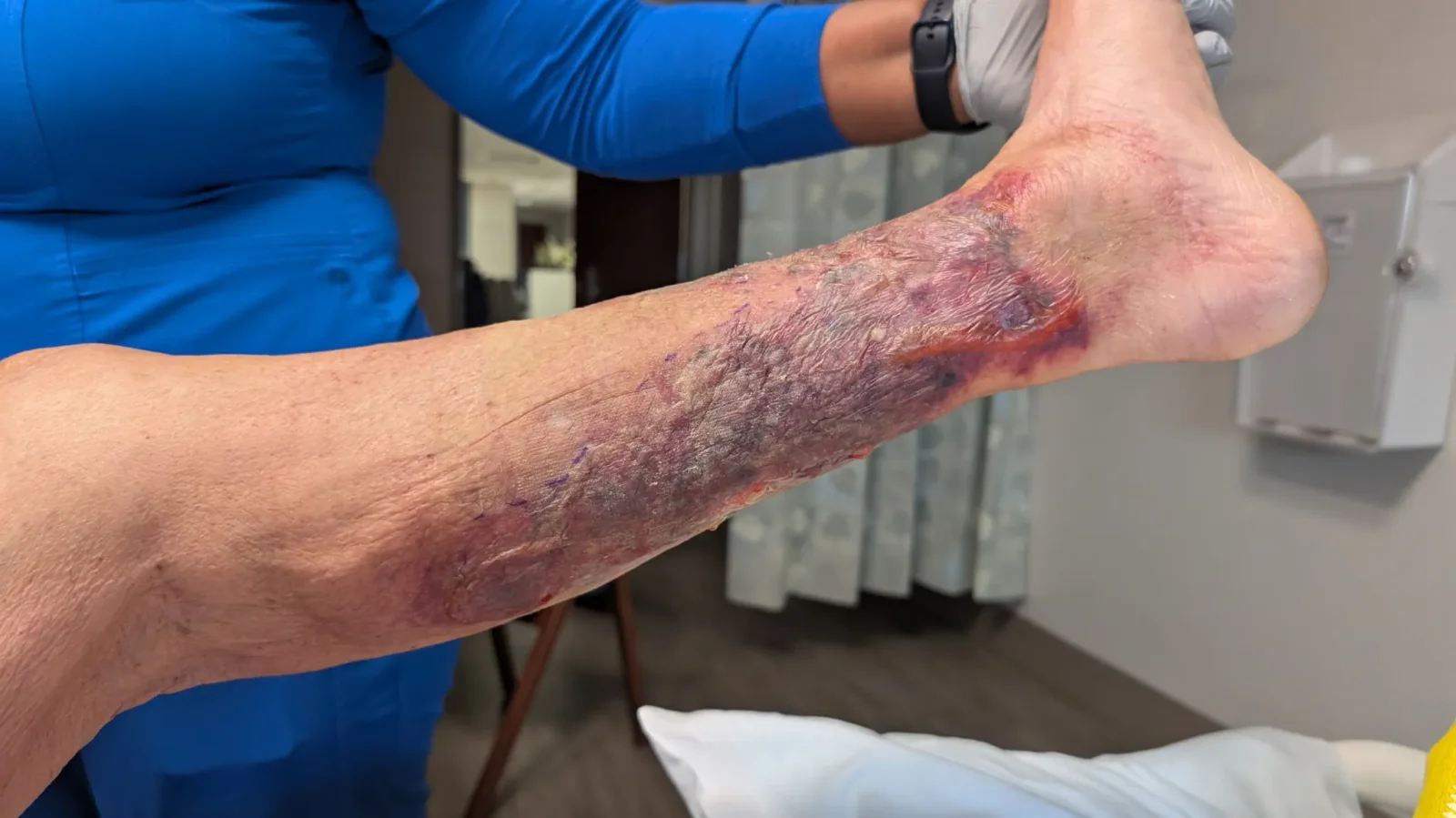 Florida reports first 2026 death from flesh-eating Vibrio vulnificus