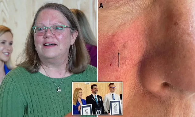 "Dermatologists discover world's tiniest skin cancer under woman's eye"