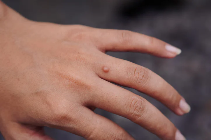Warts at home: what works and when to see a doctor