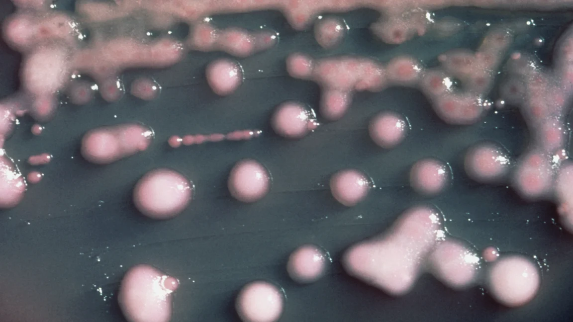 UTI-triggered Klebsiella split reveals hidden brain-virulence within a patient