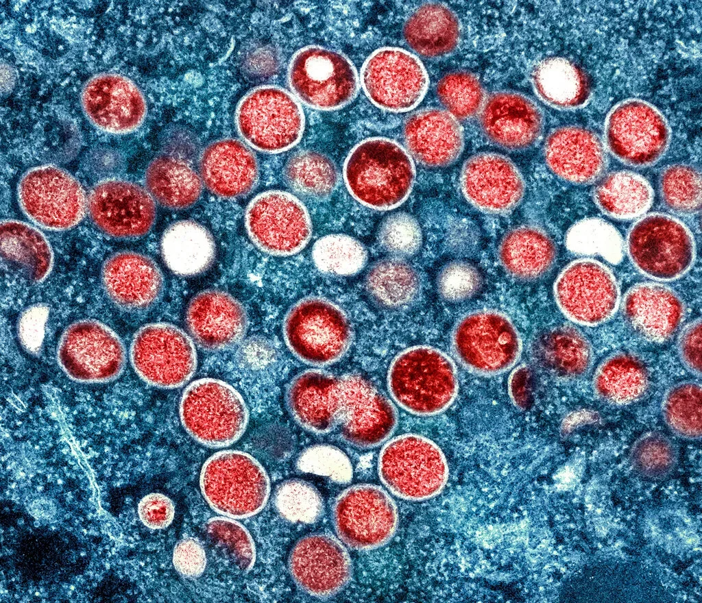 Mpox Cases on the Rise in Multiple States