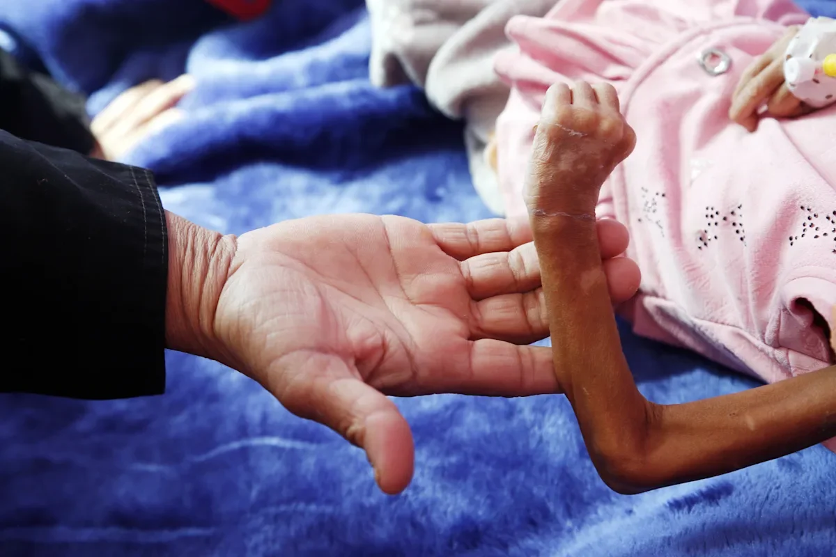 2022 Sees Over 250 Million People Suffering from Severe Hunger.