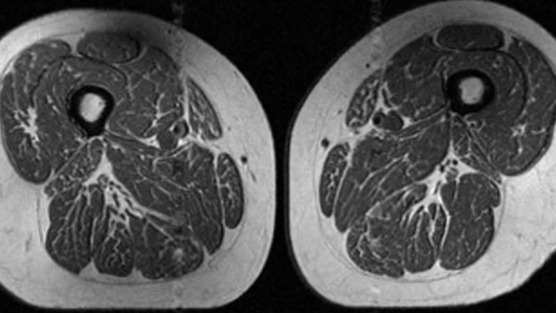 Ultra-processed diets linked to fatty thigh muscles and knee joint risk