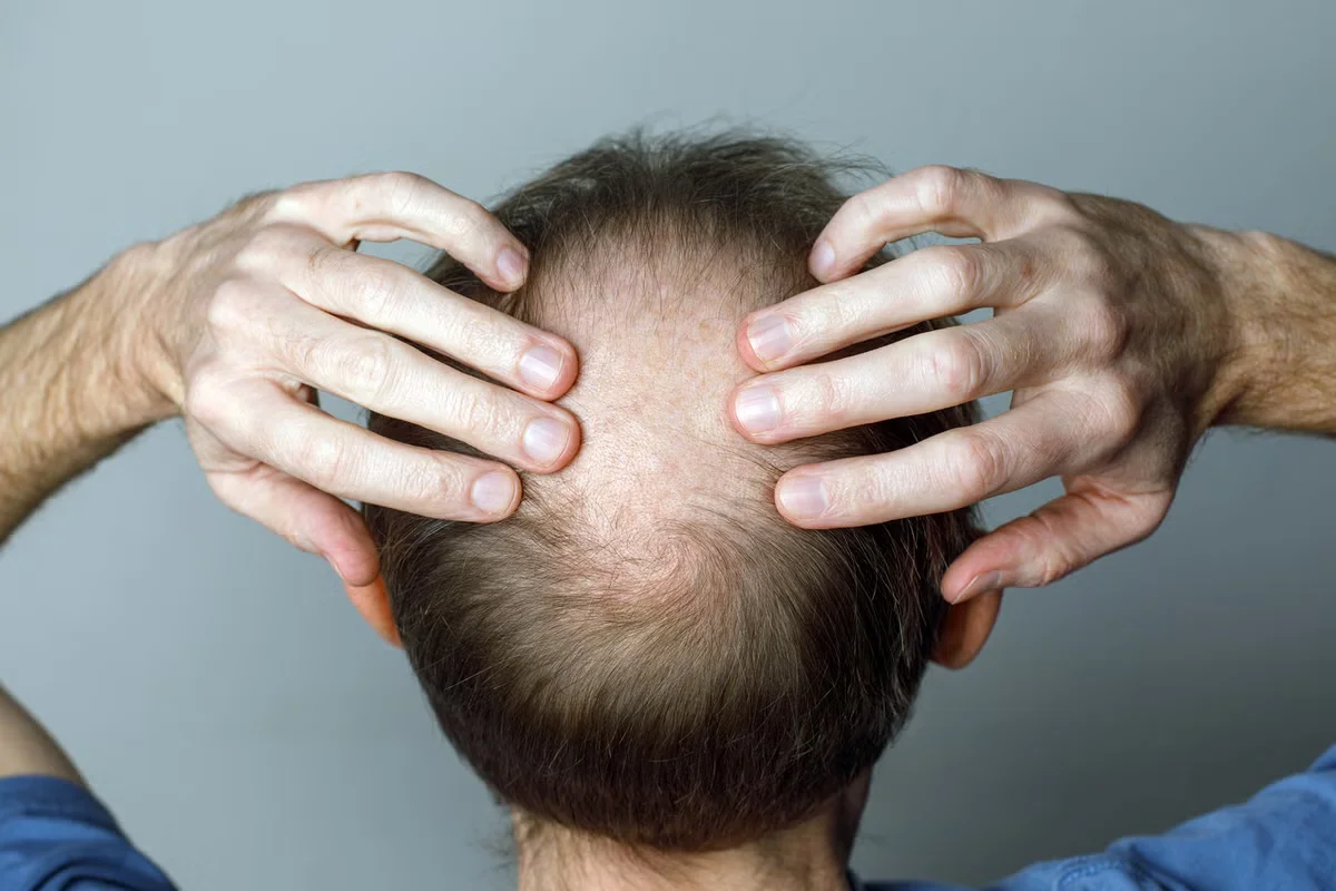 Hair loss linked to GLP-1 weight-loss drugs in new study