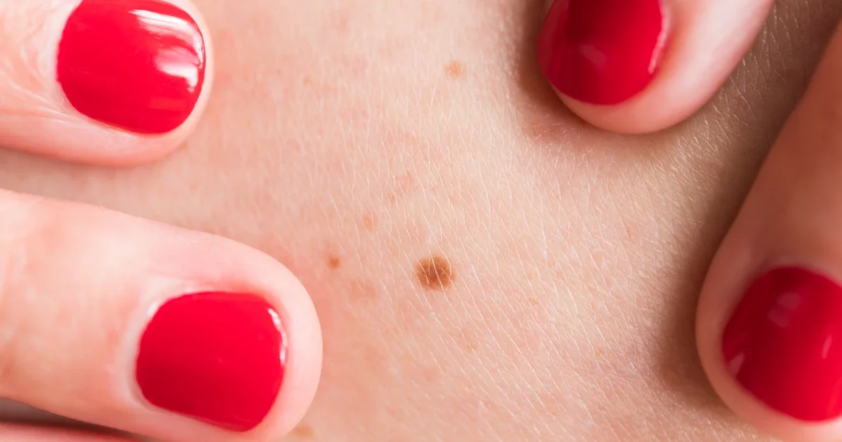 Dermatologist's Personal Vigilance for Early Skin-Cancer Detection