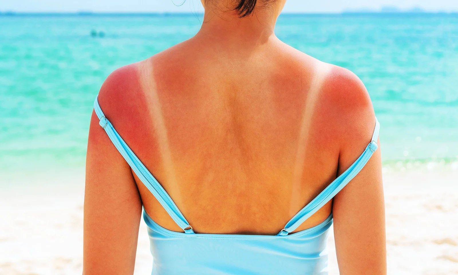 RNA damage takes center stage in sunburn science