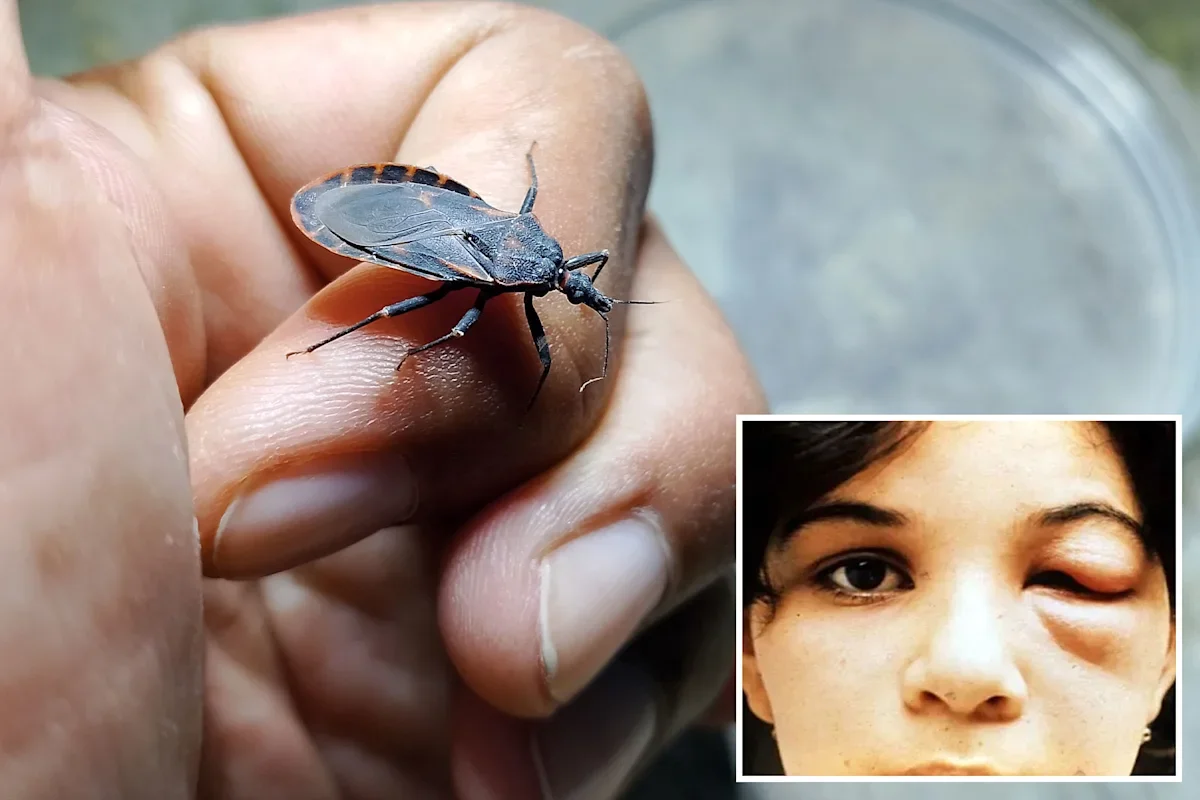 Southern California reports its first locally acquired Chagas disease case linked to kissing bugs
