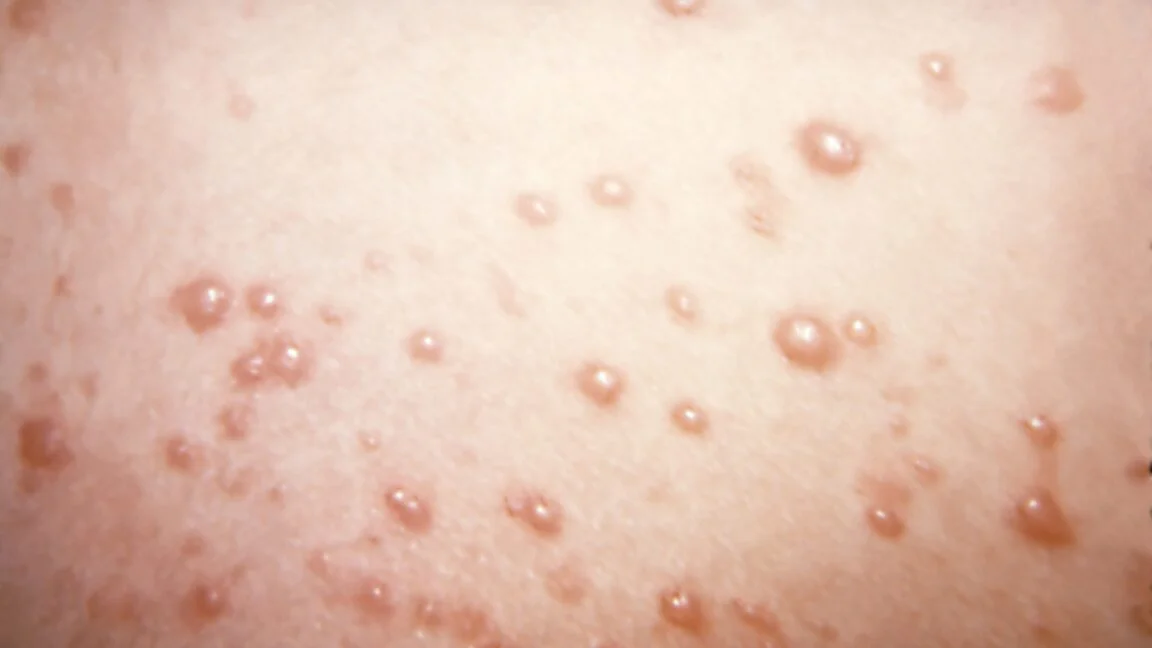Rare eruptive keloids sprout from chickenpox scars in a teen