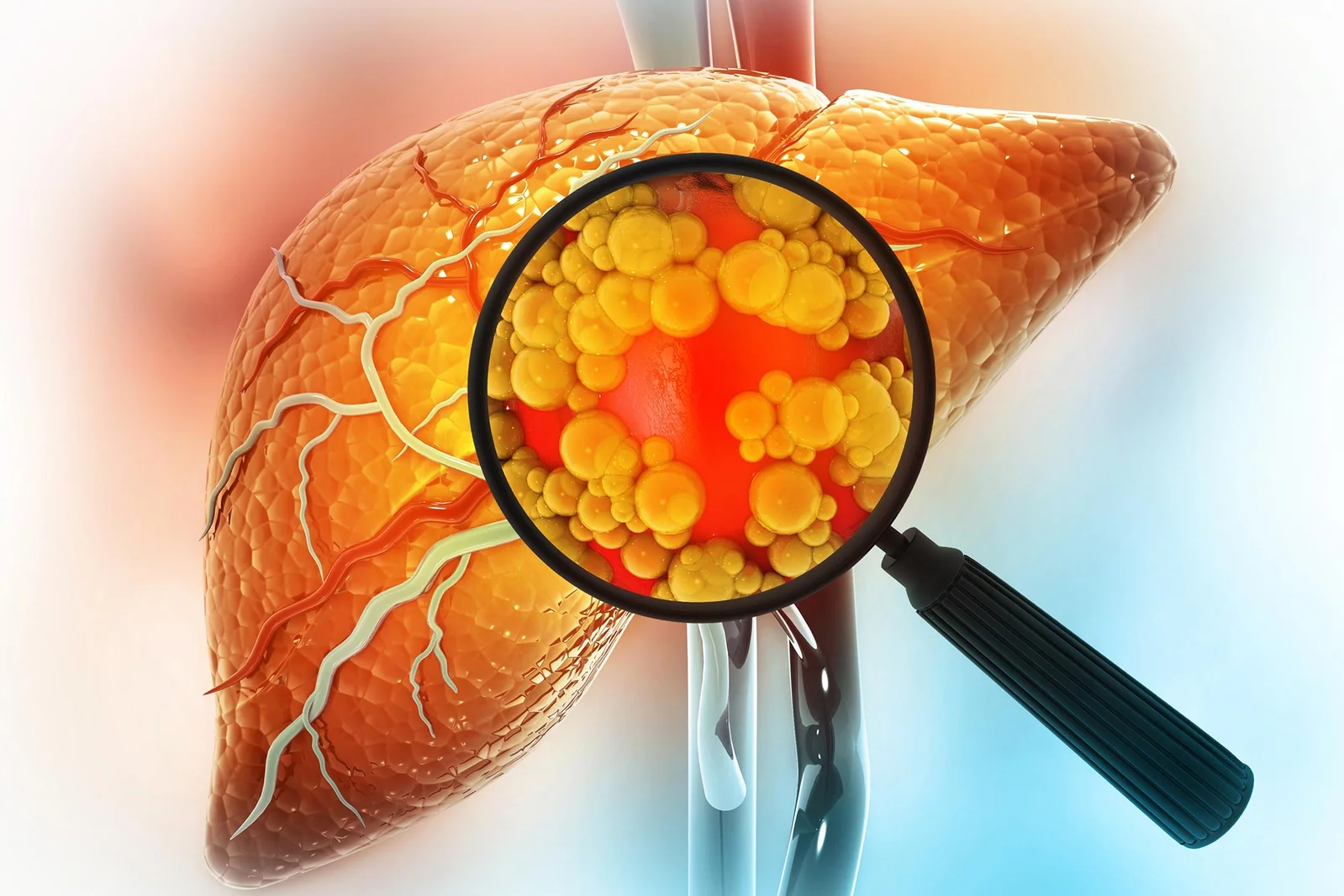 AI Blood Test Uncovers Hidden Liver Disease Before Symptoms